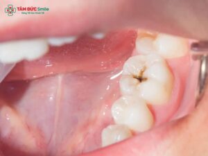 Nhét gì vào răng sâu cho đỡ đau? Cách xử lý răng sâu an toàn