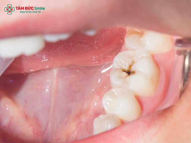 Nhét gì vào răng sâu cho đỡ đau? Cách xử lý răng sâu an toàn