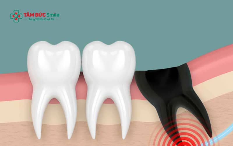 Đau nhức kéo dài, sưng mủ, chảy dịch bất thường hoặc sốt là những dấu hiệu cảnh báo nhiễm trùng sau khi nhổ răng khôn