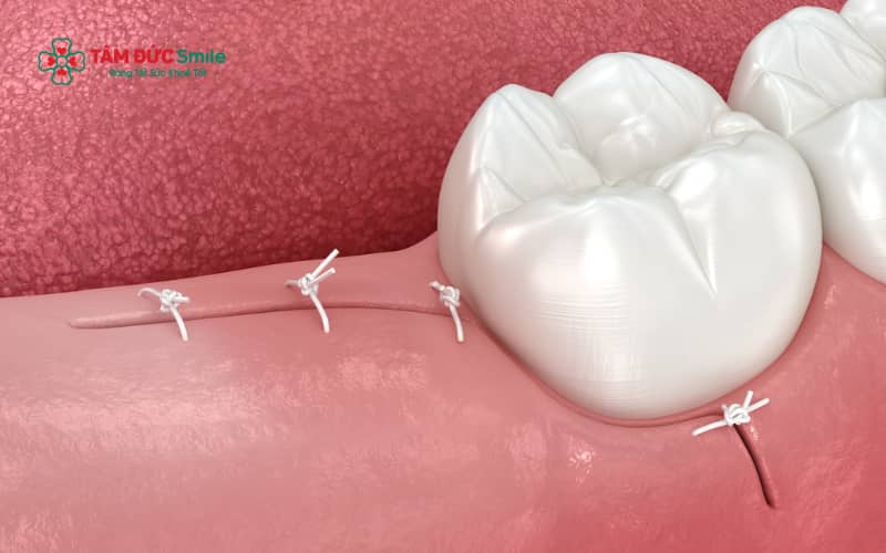 Nhiễm trùng sau nhổ răng khôn có thể xảy ra do vệ sinh không đúng cách, viêm ổ răng khô hoặc cơ địa và bệnh lý nền của người bệnh