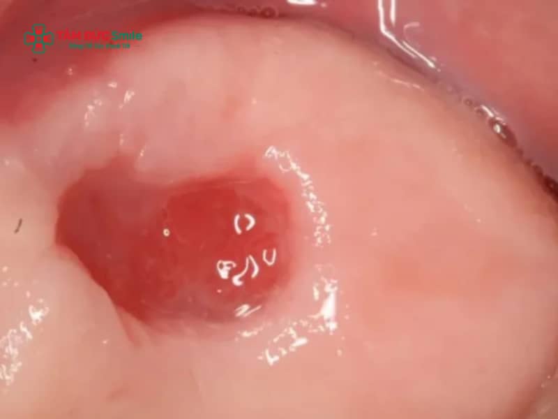 Nhiễm trùng sau khi nhổ răng khôn: Dấu hiệu, nguyên nhân, cách xử lý