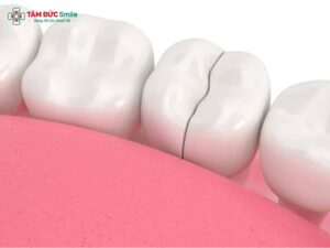 Răng bị nứt có tự lành không? Dấu hiệu răng nứt nhẹ, nứt dọc, nứt ngang và cách xử lý