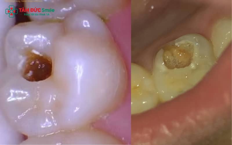 Sâu lỗ to là dấu hiệu răng đã bị phá hủy nặng, men và ngà răng không còn khả năng tự hồi phục