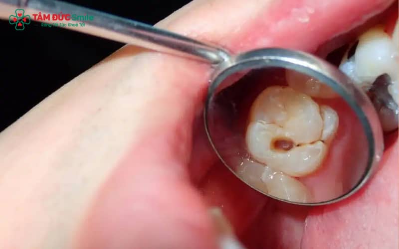Răng sâu lỗ to là tình trạng men và ngà răng bị phá hủy nhiều, tạo hố sâu rộng và dễ lan xuống tủy