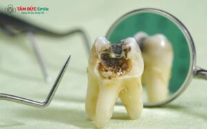 Sâu răng nhẹ đánh răng có hết không? Nguyên nhân, cách trị hiệu quả và phòng ngừa ABC88 com đăng nhập