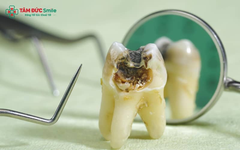Sâu răng nhẹ đánh răng có hết không? Nguyên nhân, cách trị hiệu quả và phòng ngừa ABC88 com đăng nhập