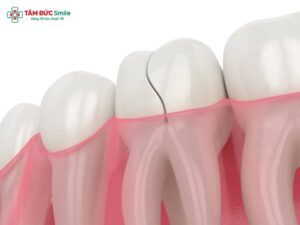 Răng hàm bị nứt đôi: nguyên nhân, dấu hiệu răng nứt và cách xử lý hiệu quả