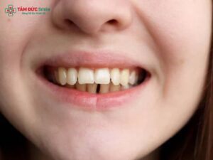 Răng hô vẩu là gì? Nguyên nhân, dấu hiệu và cách khắc phục răng hô vẩu hiệu quả