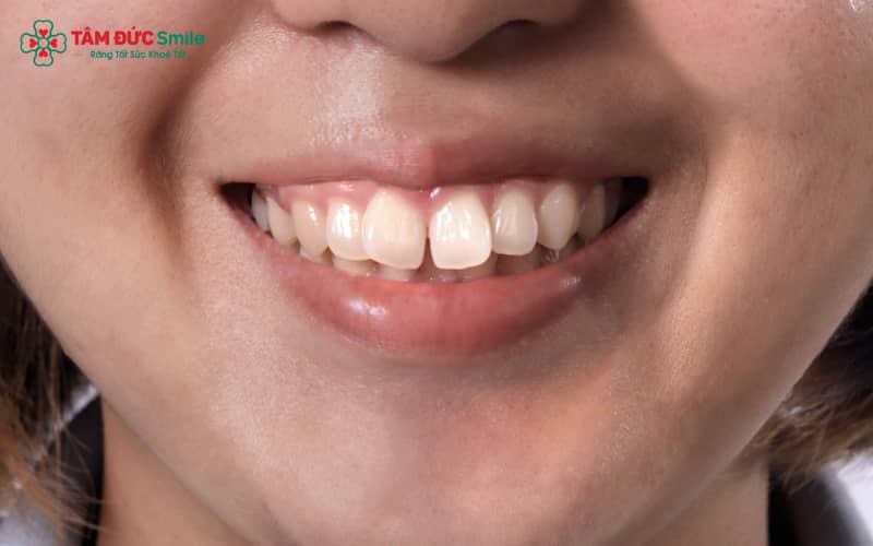 Răng hô là tình trạng răng hoặc hàm trên đưa ra quá mức, làm gương mặt mất cân đối
