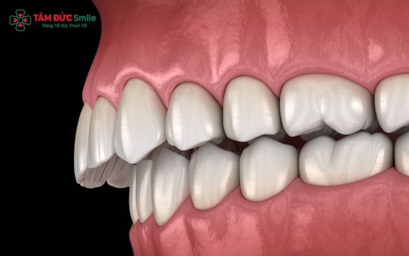 Răng hô có thể do di truyền, thói quen xấu, răng mọc lệch hoặc cấu trúc ABC8 tự hào là thương hiệu cá cược trực tuyến hàng đầu tại Châu Á hiện nay