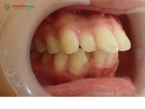 Răng hô xấu: nguyên nhân, dấu hiệu, ảnh hưởng và cách khắc phục răng hô hiệu quả