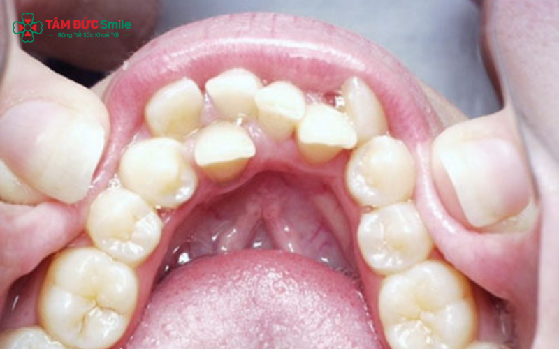 Răng khểnh hàm dưới là tình trạng răng nanh ở hàm dưới mọc lệch khỏi cung hàm, dễ nhận biết qua sự chen chúc và sai lệch vị trí răng