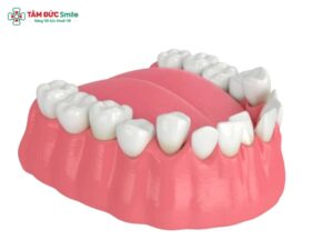Răng khểnh hàm dưới: đặc điểm, ảnh hưởng và phương pháp cải thiện