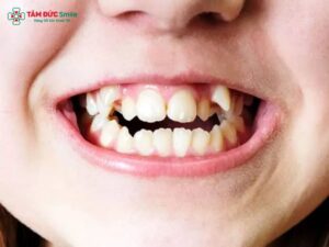 Răng khểnh mọc như thế nào? Có nên nhổ răng khểnh hay không?