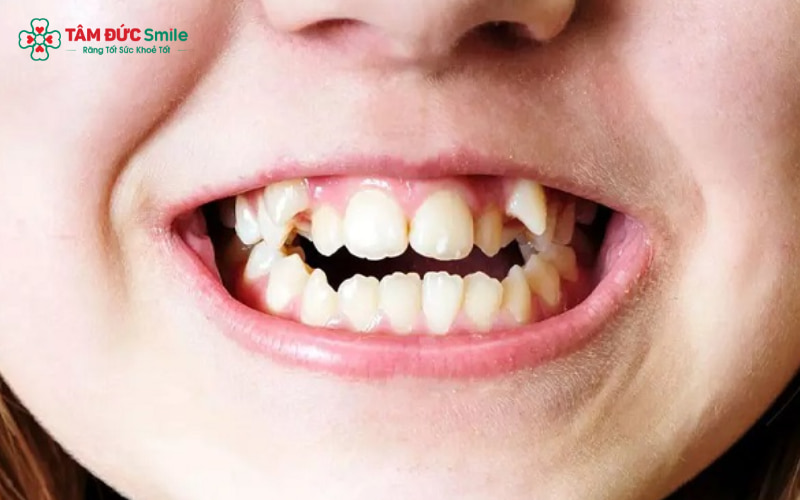Răng khểnh mọc quá cao không chỉ ảnh hưởng Abc8c1 com khuyến mãi hấp dẫn ABC8 được thành lập vào năm 2011 hoạt động đến hiện tại mà còn làm sai khớp cắn, tăng nguy cơ viêm nướu và suy giảm chức năng ăn nhai.