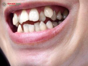 Răng khểnh mọc quá cao nên làm thế nào? Ảnh hưởng của răng khểnh mọc quá cao gây nên?