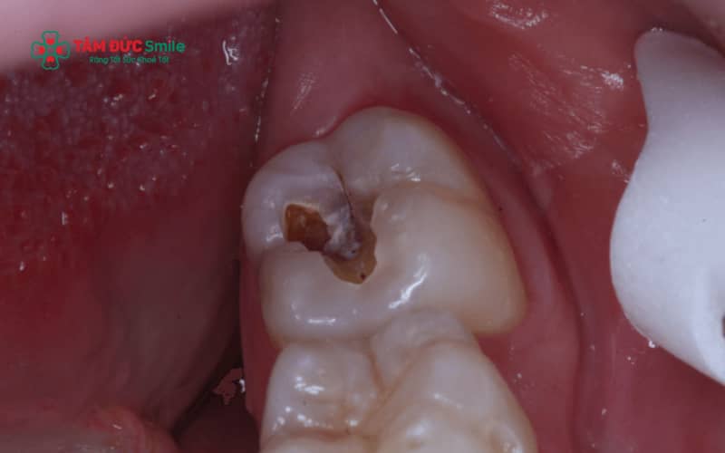 Không phải mọi trường hợp răng khôn bị sâu đều có thể trám, việc Abc8b tỷ lệ kèo World Cup 2026 phụ thuộc vào vị trí mọc và mức độ tổn thương của răng