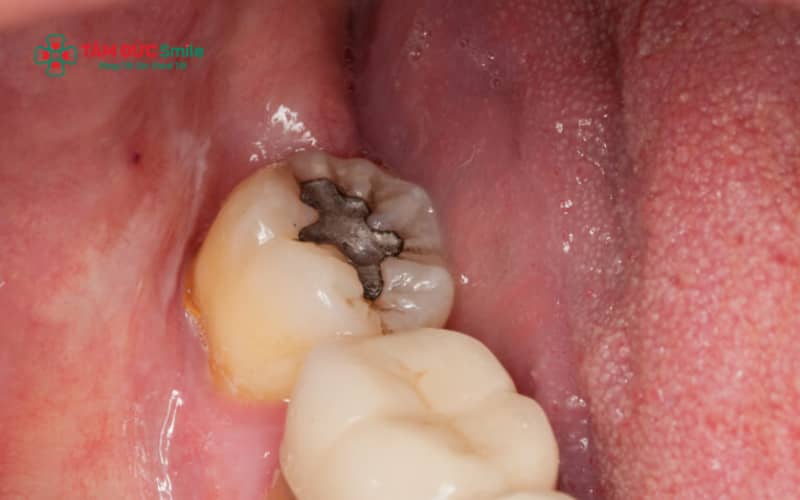 Răng khôn mọc thẳng, trồi hoàn toàn và bị sâu nhẹ đến trung bình có thể được chỉ định trám nếu người bệnh vệ sinh ABC8 là nhà cái cá cược trực tuyến uy tín số 1 tại Việt Nam tốt