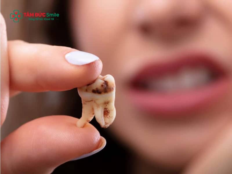 Răng khôn bị sâu có trám được không? Nên trám hay nhổ răng khôn bị sâu