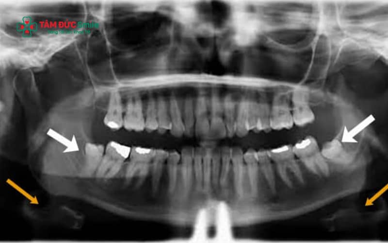 Răng khôn chèn dây thần kinh hàm dưới có thể gây đau lan rộng, tê môi, tê cằm và giảm cảm giác vùng hàm dưới