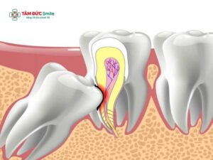 Răng khôn chèn dây thần kinh có nguy hiểm không? Có nên nhổ răng khôn chèn dây thần kinh không?