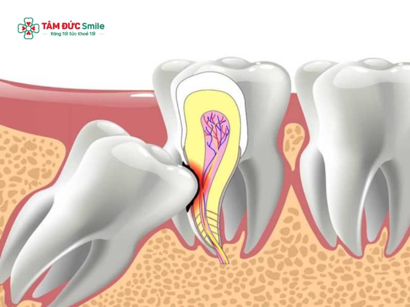 Răng khôn chèn dây thần kinh có nguy hiểm không? Có nên nhổ răng khôn chèn dây thần kinh không?