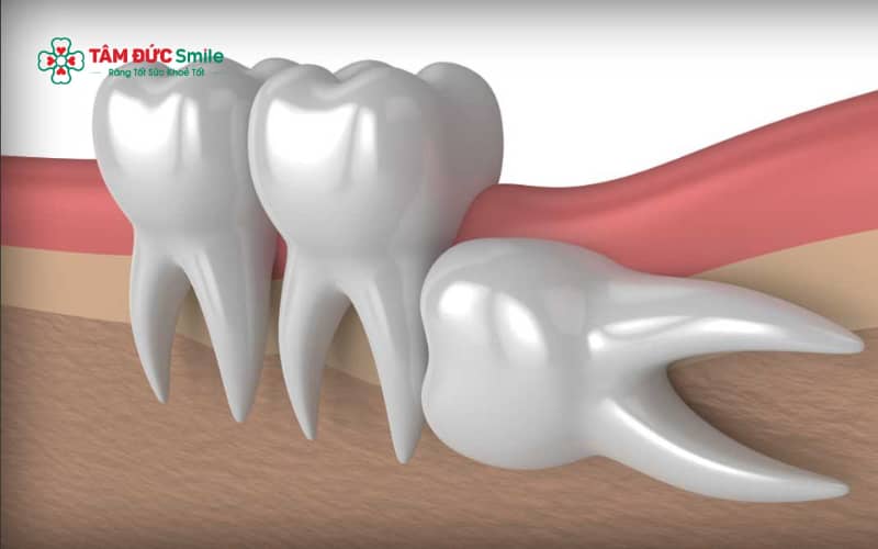Răng khôn mọc lệch 90 độ thường không có chức năng ăn nhai và tiềm ẩn nhiều nguy cơ, nên đa số trường hợp được ABC8 đường link chính thức chỉ định nhổ sớm