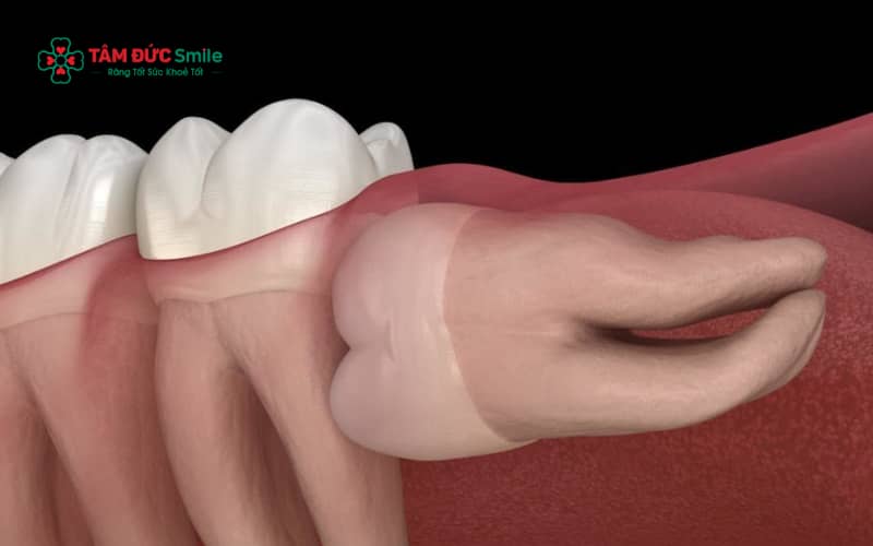 Răng khôn mọc lệch 90 độ có thể gây đau nhức kéo dài, viêm nhiễm tái phát và ảnh hưởng trực tiếp đến các răng kế cận nếu không Abc8b tỷ lệ kèo World Cup 2026