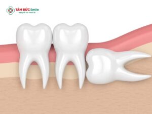 Răng khôn mọc lệch 90 độ có nguy hiểm không và khi nào nên nhổ