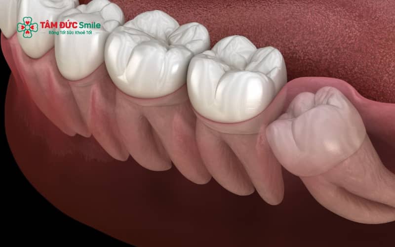 Răng khôn mọc lệch nếu không nhổ có thể gây đau nhức kéo dài và tiềm ẩn nhiều biến chứng nguy hiểm cho răng kế cận