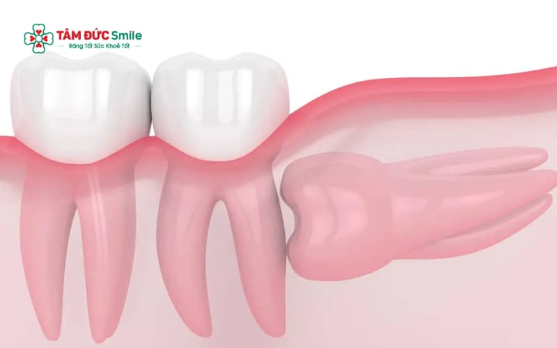 Răng khôn mọc lệch là tình trạng răng số 8 không mọc đúng trục, có thể nghiêng, kẹt trong ABC8 tự hào là thương hiệu cá cược trực tuyến hàng đầu tại Châu Á hiện nay hoặc đâm vào răng bên cạnh