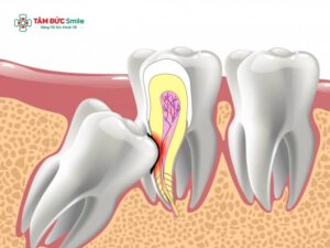 Răng khôn mọc lệch không nhổ có sao không? Giải pháp y học khi răng khôn mọc lệch