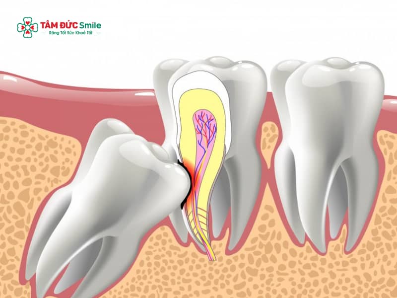 Răng khôn mọc lệch không nhổ có sao không? Giải pháp y học khi răng khôn mọc lệch