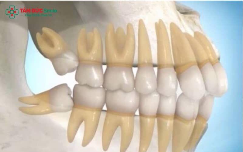 Răng khôn mọc lệch dù không gây đau vẫn có thể tiềm ẩn nhiều nguy cơ và cần được ABC8 đường link chính thức đánh giá kỹ trước khi quyết định nhổ