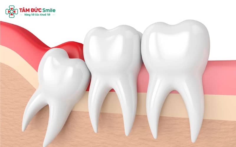Răng khôn mọc lệch không đau có thể gây ABC88 com đăng nhập số 7, viêm lợi trùm tái phát và tiêu xương ổ răng nếu không xử lý sớm