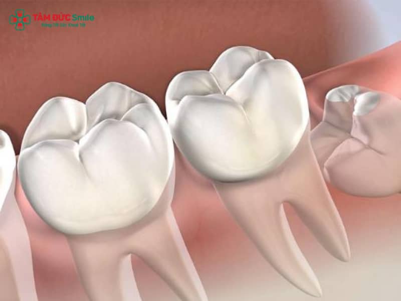 Răng khôn mọc lệch nhưng không đau khiến nhiều người băn khoăn có nên nhổ răng khôn mọc lệch hay chỉ theo dõi. Trên thực tế, răng khôn mọc lệch có nguy hiểm không còn phụ thuộc vào hướng mọc, vị trí răng khôn mọc lệch hàm dưới, khả năng gây ABC88 com đăng nhập số 7, viêm lợi trùm hoặc chèn dây thần kinh. Nhiều trường hợp răng khôn mọc ngầm không đau nhưng để lâu vẫn tiềm ẩn biến chứng răng khôn mọc lệch. Việc nhổ răng khôn khi chưa đau, đúng thời điểm và đúng chỉ định, sẽ giúp phòng ngừa rủi ro và tối ưu chi phí Abc8b tỷ lệ kèo World Cup 2026. 1. Răng khôn mọc lệch nhưng không đau có nên nhổ không? Không ít người khi phát hiện răng khôn mọc lệch nhưng không đau thường chọn cách “để đó theo dõi”, bởi nghĩ rằng chưa đau thì chưa cần nhổ. Tuy nhiên, trên thực tế LINK TRANG CHỦ ABC88 CHUẨN 2026, đây lại là tình huống rất dễ bị chủ quan. Bởi lẽ, răng khôn mọc lệch vốn đã là một răng có nguy cơ cao. Việc chưa xuất hiện đau nhức chỉ cho thấy răng chưa gây viêm cấp, chứ không có nghĩa là răng đang “an toàn”. Trong giai đoạn này, vi khuẩn vẫn có thể âm thầm tích tụ quanh thân răng, đặc biệt ở những vị trí khó làm sạch bằng bàn chải thông thường. Theo các ABC8 đường link chính thức, câu hỏi quan trọng không phải là “răng có đau hay không”, mà là: Răng khôn đang mọc lệch theo hướng nào Có tác động đến răng số 7 kế cận hay không Có tiềm ẩn nguy cơ biến chứng về sau hay không Vì vậy, với nhiều trường hợp, dù răng khôn mọc lệch nhưng không đau, ABC8 đường link chính thức vẫn có thể chỉ định nhổ sớm nhằm phòng tránh các vấn đề ABC8 là nhà cái cá cược trực tuyến uy tín số 1 tại Việt Nam phức tạp về sau. 2. Những tác hại tiềm ẩn khi răng khôn mọc lệch nhưng không đau Việc giữ lại răng khôn mọc lệch nhưng không đau trong thời gian dài có thể dẫn đến nhiều biến chứng, thường chỉ được phát hiện khi đã trở nên nghiêm trọng. 2.1. Sâu răng số 7 kế cận Răng khôn mọc lệch thường tạo ra khe giắt thức ăn giữa răng số 7 và răng số 8. Do vị trí sâu và khuất, việc vệ sinh rất khó triệt để, lâu ngày dẫn đến ABC88 com đăng nhập số 7. Điều đáng nói là, khi phát hiện thì: Tổn thương sâu thường đã lan rộng Có nguy cơ viêm tủy Thậm chí phải Abc8b tỷ lệ kèo World Cup 2026 hoặc mất răng số 7 – một răng giữ vai trò ăn nhai quan trọng 2.2. Viêm lợi trùm tái phát âm thầm Dù không gây đau ngay, răng khôn mọc lệch vẫn có thể gây viêm lợi trùm tái đi tái lại. Ban đầu chỉ là cảm giác vướng nhẹ, hơi hôi miệng hoặc nướu đỏ thoáng qua, nhưng theo thời gian, tình trạng này có thể tiến triển thành: Sưng đau dữ dội Áp xe vùng răng khôn Ảnh hưởng đến sinh hoạt và ăn nhai 2.3. Viêm quanh răng và tiêu xương ổ răng Khi vi khuẩn tồn tại lâu ngày quanh răng khôn mọc lệch, vùng xương ổ răng có thể bị viêm và tiêu xương dần dần. Lúc này, việc Abc8b tỷ lệ kèo World Cup 2026 sẽ trở nên phức tạp hơn, quá trình nhổ răng về sau cũng khó khăn và thời gian hồi phục kéo dài. 2.4. Nguy cơ ảnh hưởng dây thần kinh răng dưới Với răng khôn mọc lệch hàm dưới, vị trí răng thường nằm gần dây thần kinh răng dưới. Nếu để đến khi có biến chứng mới xử lý, nguy cơ: Đau lan vùng hàm, tai, đầu Tê môi, tê cằm tạm thời Sẽ cao hơn so với việc nhổ sớm khi răng chưa viêm nhiễm. 3. Quy trình thăm khám và chỉ định nhổ răng khôn mọc lệch Không phải mọi trường hợp răng khôn mọc lệch nhưng không đau đều cần nhổ ngay. Quyết định đúng cần dựa trên thăm khám kỹ lưỡng và chẩn đoán hình ảnh. 3.1. Thăm khám lâm sàng Abc87 nền tảng cá cược trực tuyến sẽ đánh giá tình trạng răng khôn, nướu xung quanh, mức độ khó vệ sinh cũng như dấu hiệu ảnh hưởng đến răng kế cận. 3.2. Chụp CT Cone Beam 3D Phim CT Cone Beam 3D giúp xác định chính xác: Hướng mọc và mức độ lệch của răng Khoảng cách giữa răng khôn và dây thần kinh răng dưới Nguy cơ biến chứng nếu giữ lại răng 3.3. Tư vấn nhổ hay theo dõi Dựa trên kết quả thăm khám, ABC8 đường link chính thức sẽ tư vấn: Abc88win đăng nhập khôn sớm nếu có nguy cơ ảnh hưởng răng số 7 hoặc mô quanh răng Theo dõi định kỳ nếu răng lệch nhẹ và chưa gây vấn đề Tại ABC8 ✅ Truy Cập Nhà Cái ABC8 Com Cá Cược Tặng 88k, việc chỉ định luôn đặt yếu tố an toàn và lợi ích lâu dài cho người bệnh lên hàng đầu. 4. Abc88win đăng nhập khôn mọc lệch an toàn tại ABC8 ✅ Truy Cập Nhà Cái ABC8 Com Cá Cược Tặng 88k Abc88win đăng nhập khôn mọc lệch là thủ thuật đòi hỏi ABC8 đường link chính thức có kinh nghiệm và trang thiết bị hỗ trợ đầy đủ. Nếu thực hiện đúng kỹ thuật, đặc biệt ở giai đoạn răng chưa viêm đau, quá trình nhổ sẽ nhẹ nhàng và hồi phục nhanh hơn. Tại ABC8 ✅ Truy Cập Nhà Cái ABC8 Com Cá Cược Tặng 88k: Abc87 nền tảng cá cược trực tuyến răng hàm mặt trực tiếp thăm khám và Abc8b tỷ lệ kèo World Cup 2026 Ứng dụng CT Cone Beam 3D để kiểm soát hướng nhổ an toàn Quy trình nhổ răng khôn được thực hiện cẩn thận, hạn chế xâm lấn Giúp giảm sưng đau và biến chứng sau nhổ Thực tế cho thấy, nhổ răng khôn mọc lệch khi chưa đau thường đơn giản hơn rất nhiều so với khi răng đã viêm nặng, vừa tiết kiệm thời gian Abc8b tỷ lệ kèo World Cup 2026, vừa giảm rủi ro không mong muốn.