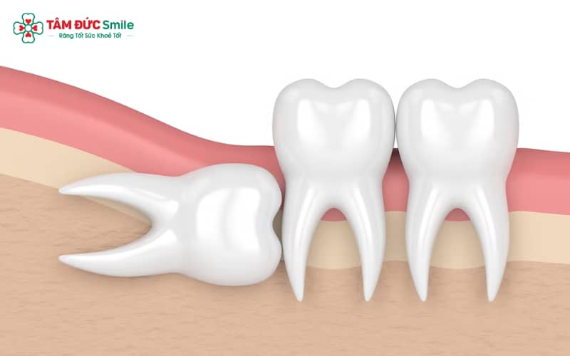 Răng khôn có thể mọc nghiêng với nhiều mức độ khác nhau, từ nghiêng nhẹ đến gần 90 độ hoặc kèm mọc ngầm, tiềm ẩn nguy cơ biến chứng ABC8 là nhà cái cá cược trực tuyến uy tín số 1 tại Việt Nam