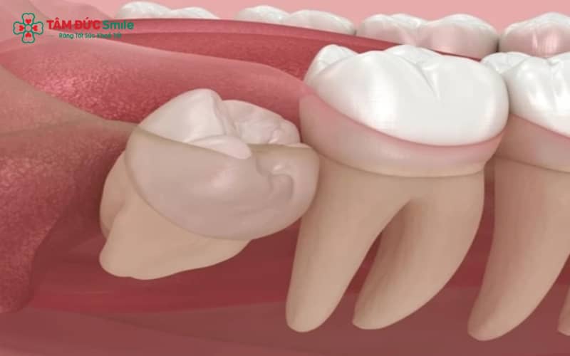Răng khôn mọc nghiêng có thể gây viêm nhiễm, đau kéo dài và ảnh hưởng răng kế cận nếu không được theo dõi và xử lý kịp thời