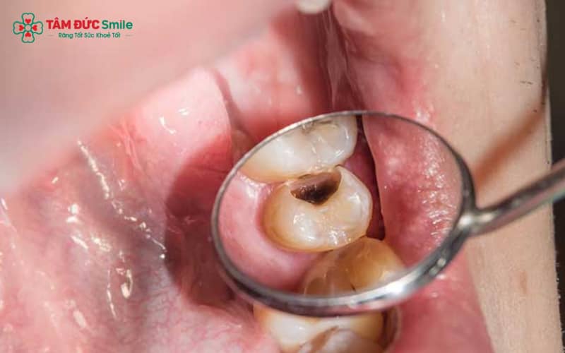 Răng sâu ăn vào ngà và sát tủy – nguyên nhân khiến cơn đau nhức ngày càng tăng