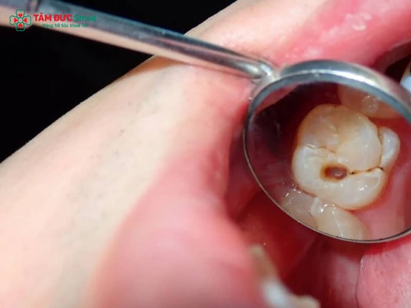 Tại sao răng sâu bị đau nhức? Nguyên nhân, tác hại và cách giảm đau