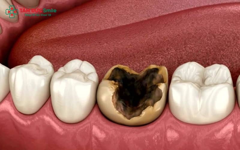 Răng vỡ chỉ còn Abc8com giaitri tructuyen có thể gây nhiễm trùng, áp xe, tiêu xương và tăng nguy cơ mất răng vĩnh viễn
