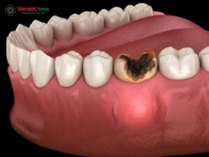 Răng sâu vỡ còn Abc8com giaitri tructuyen phải làm sao? Cách xử lý răng sâu vỡ nặng hiệu quả