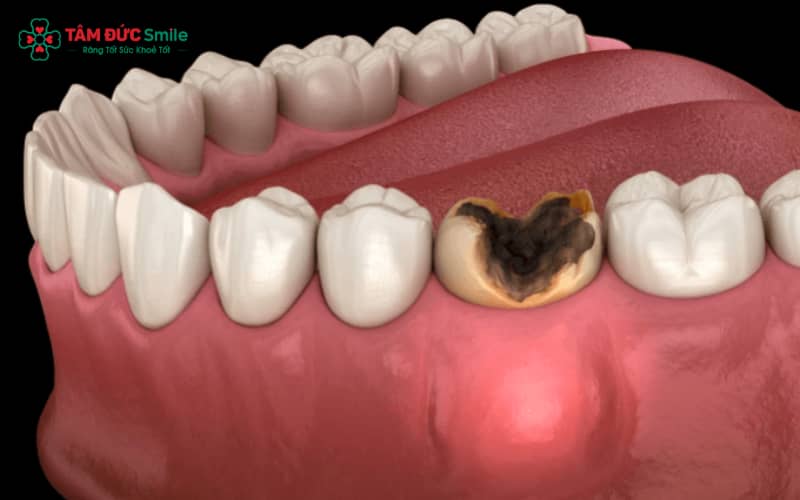 Răng sâu vào tủy thường do vệ sinh kém, ăn nhiều đường, men răng yếu và bỏ qua các lỗ sâu nhỏ
