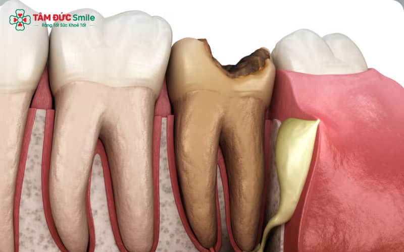 Đau đêm, đau tự phát, nhạy cảm nhiệt và sưng nướu là dấu hiệu răng sâu đã lan vào tủy
