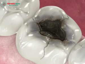 Răng số 6 bị sâu nặng có nguy hiểm không? Dấu hiệu, nguyên nhân, phương pháp Abc8b tỷ lệ kèo World Cup 2026