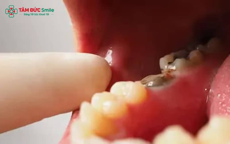 Răng số 8 thường mọc lệch hoặc mọc ngầm, nằm sâu trong cung hàm nên dễ tích tụ thức ăn và vi khuẩn, làm tăng nguy cơ ABC88 com đăng nhập