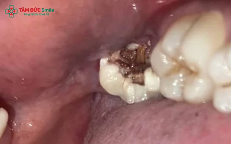 Khi răng số 8 bị sâu gây đau nhức, viêm nhiễm hoặc tái phát nhiều lần, nhổ răng khôn thường là giải pháp an toàn