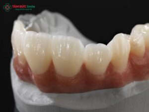 rang-su-ceramill-gia-bao-nhieu-2