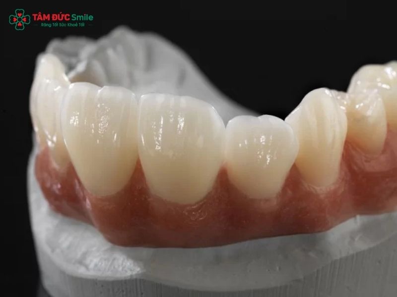 rang-su-ceramill-gia-bao-nhieu-2