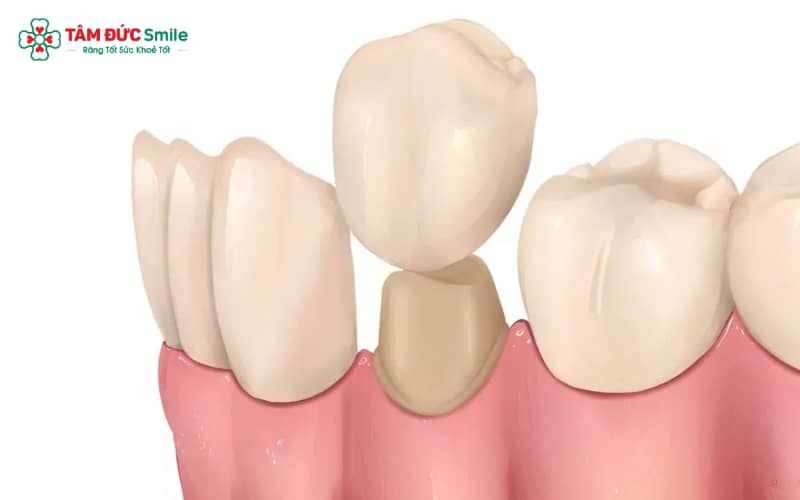 Những sai lầm khi Abc8.com Thể thao, Đá gà, Xổ số, Bắn cá như mài răng quá nhiều, lấy dấu sai hoặc chọn vật liệu kém chất lượng khiến răng dễ đau nhức và viêm nướu